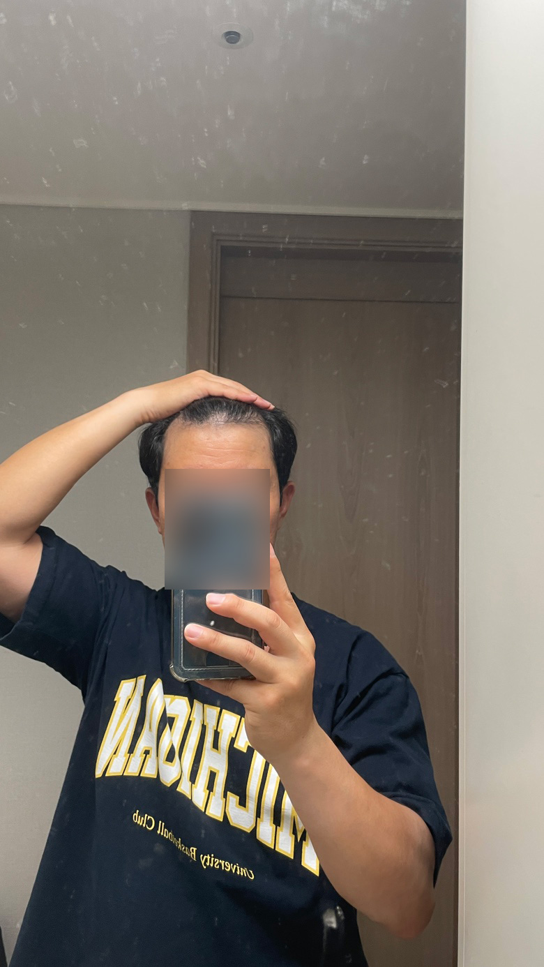 모원성형외과 무삭발 비절개모발이식+두피문신 7개월