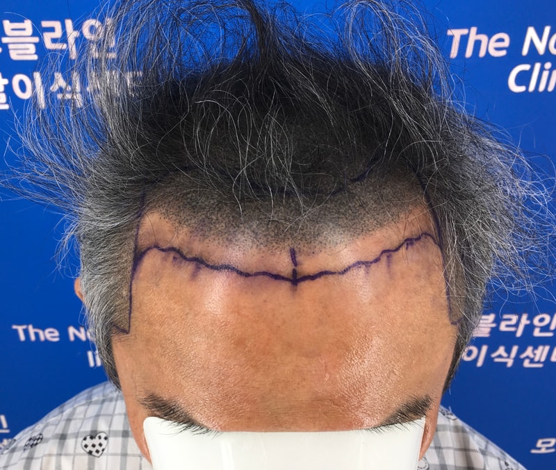 인생이 달라진 대량이식 12개월 후기 입니다.