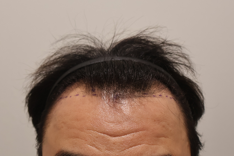 인천마이모의원원장님 1000모낭 한달 후기입니다