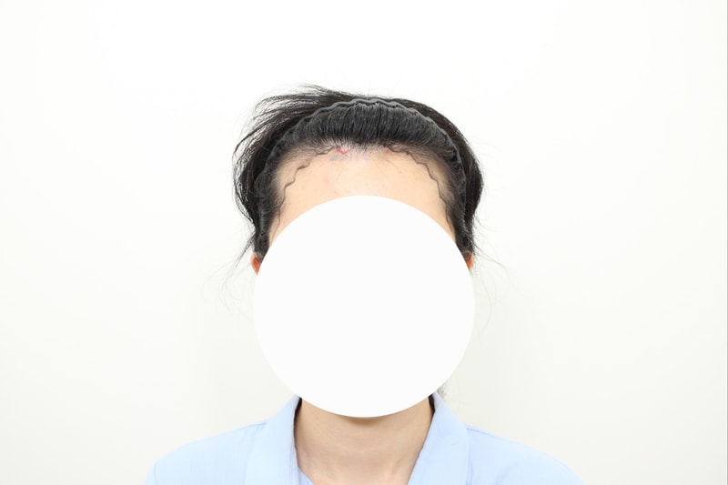 헤어라인 모발이식 6개월 후기