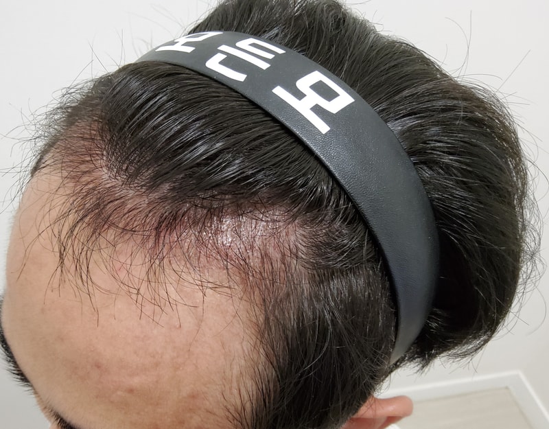 3. 수술후_3개월_2.jpg