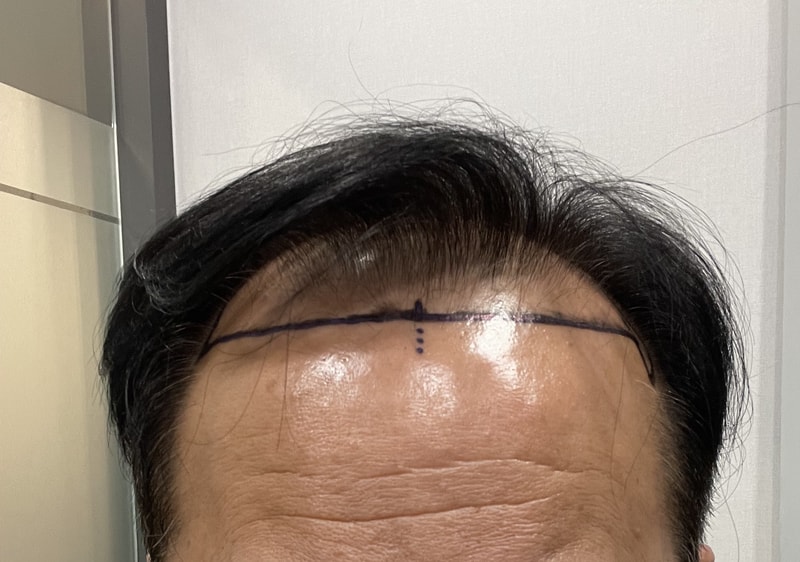 다나성형외과 비절개모발이식 6000모의 기적^^ 공개합니다 (18개월차후기)
