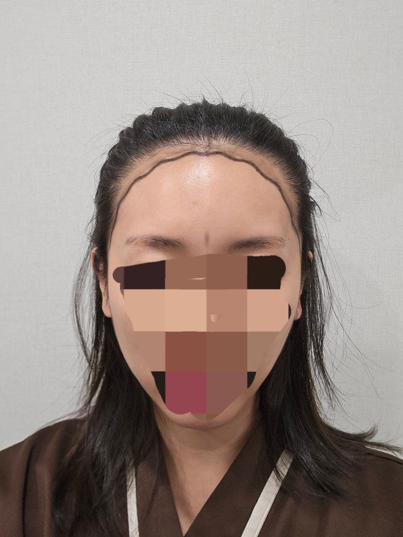 모우다에서 두번째 모발이식!!!비절개 1500모