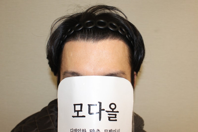 모다올의원 양유군 원장님 수술 후기(6개월차)