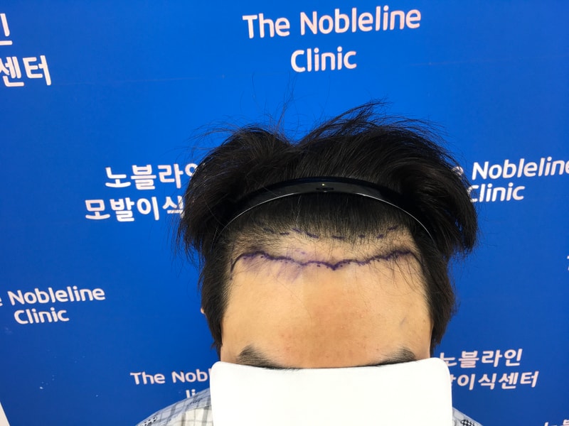 6개월 전 수술 후 미국에서 잘 지내고 있습니다.