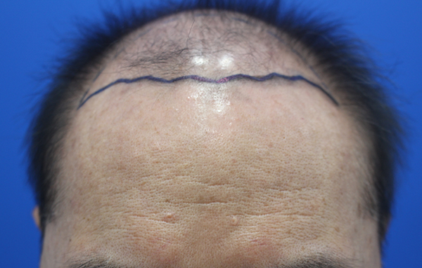 3500모 이식 받았습니다.(한나이브 성형외과)