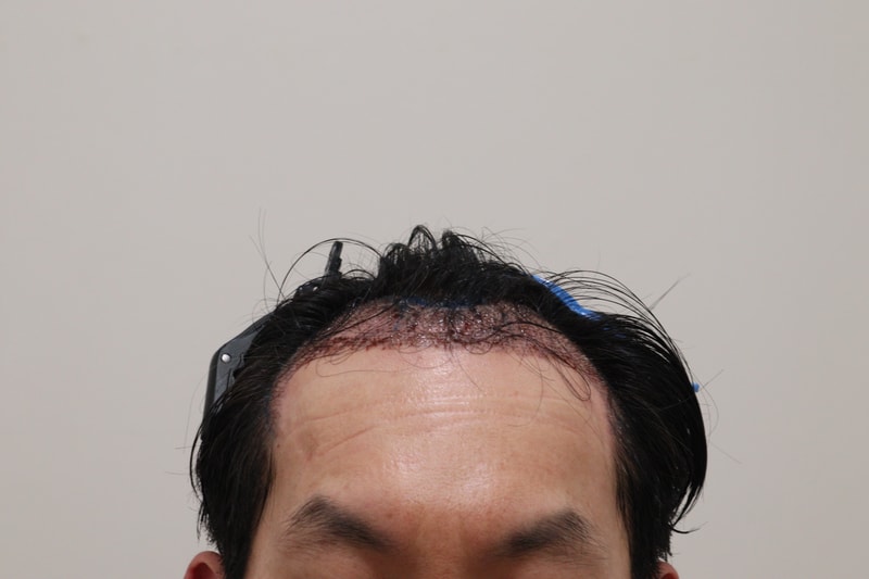 2. 수술후_1일_1.JPG