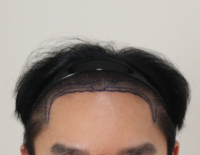 두피문신했다가 결국 이식했습니다.