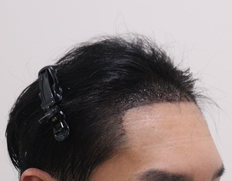2. 수술후_1일_3.JPG