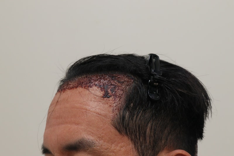 2. 수술후_1일_2.JPG