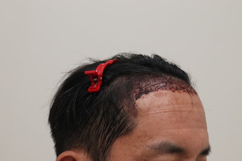 2. 수술후_1일_3.JPG