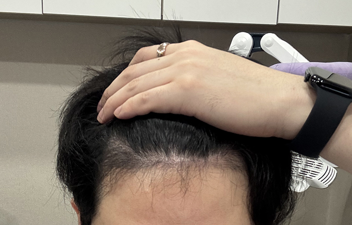 4. 이제 슬슬 암흑기가 끝나는 것 같습니다 길게 보이는 머리카락은 안 빠진 이식모 그대로 자란거예요.jpg