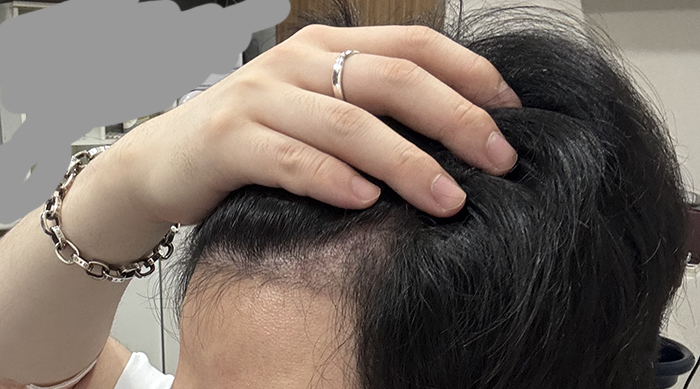 6. PRP 주사를 맞고 있어서 병원갈 땐 패딩안에 반팔입고 갑니다 피 뽑아야해서 반팔이 편하네요.jpg