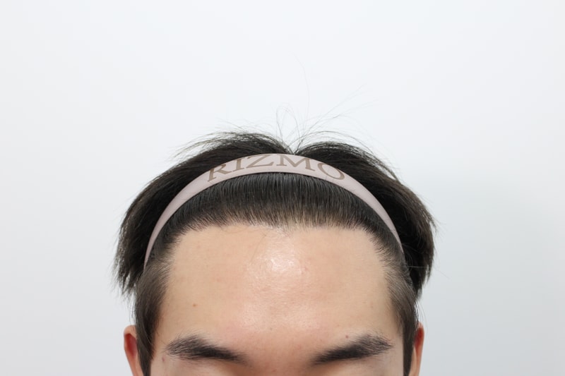 수술 후 정면.jpg