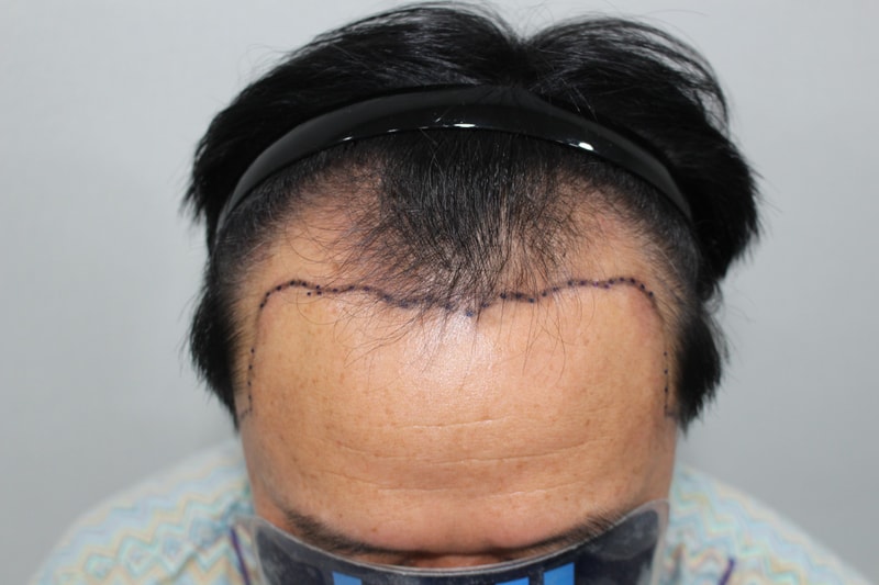 Non-cut Hair Transplant (Moderhamm Clinic — Hair Transplant Center Jeong Hanbyul)