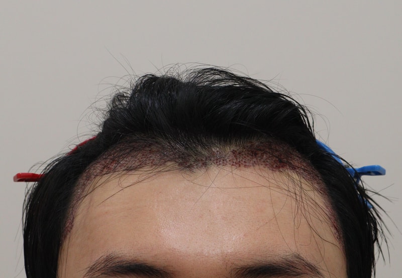 2. 수술후_1일_1.JPG