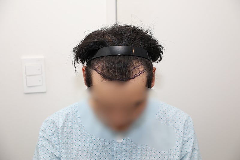 6 months of Hair Transplant review