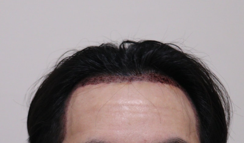 2. 수술후_1일_1.JPG