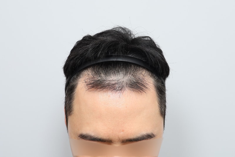 헤어라인 무삭발모발이식수술 2주차 모원성형외과 정재홍원장님