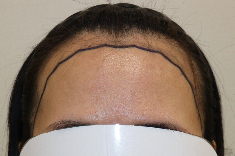 It's been 9 months since the HAIRO HAIR TRANSPLANT CENTER Daegu of 3,200 Mo.