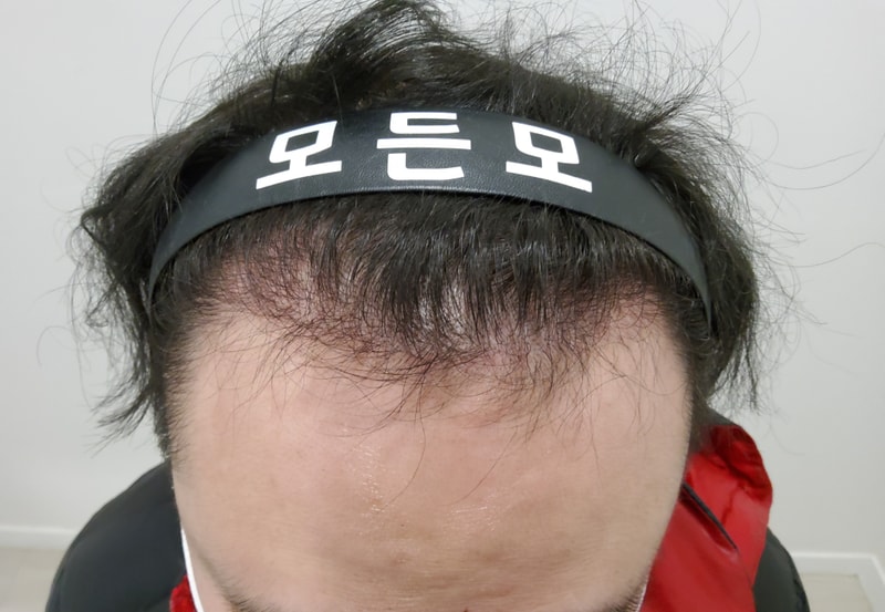 4. 수술후_6개월_1.jpg