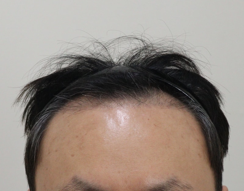 3. 수술후_3개월_1.JPG