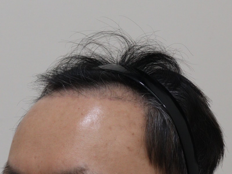 3. 수술후_3개월_2.JPG