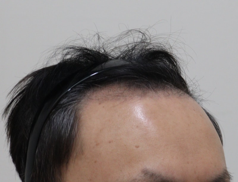 3. 수술후_3개월_3.JPG