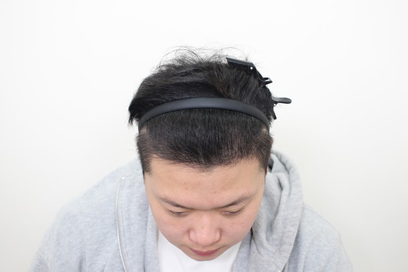 모발이식 180일차 후기