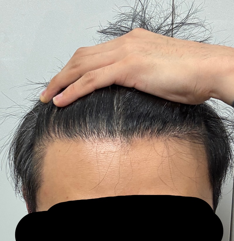 1400 follicles are enough for a little m-correcting purpose.
