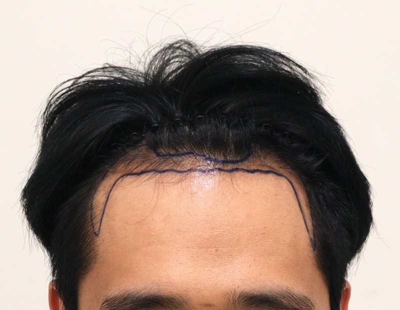 1. 수술전_1.JPG