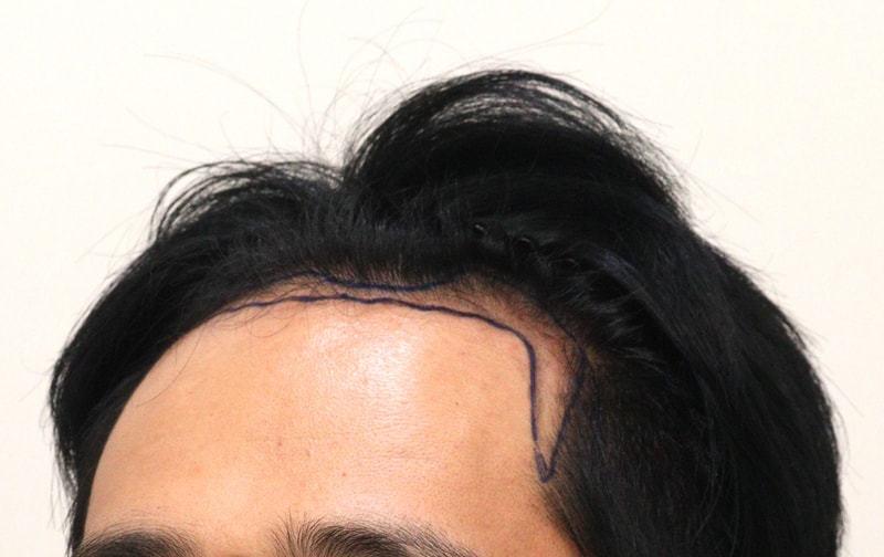 1. 수술전_2.JPG