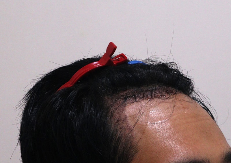2. 수술후_1일_3.JPG