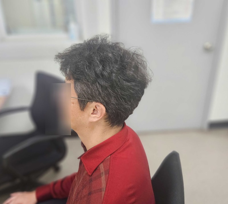 모발이식후기.jpg