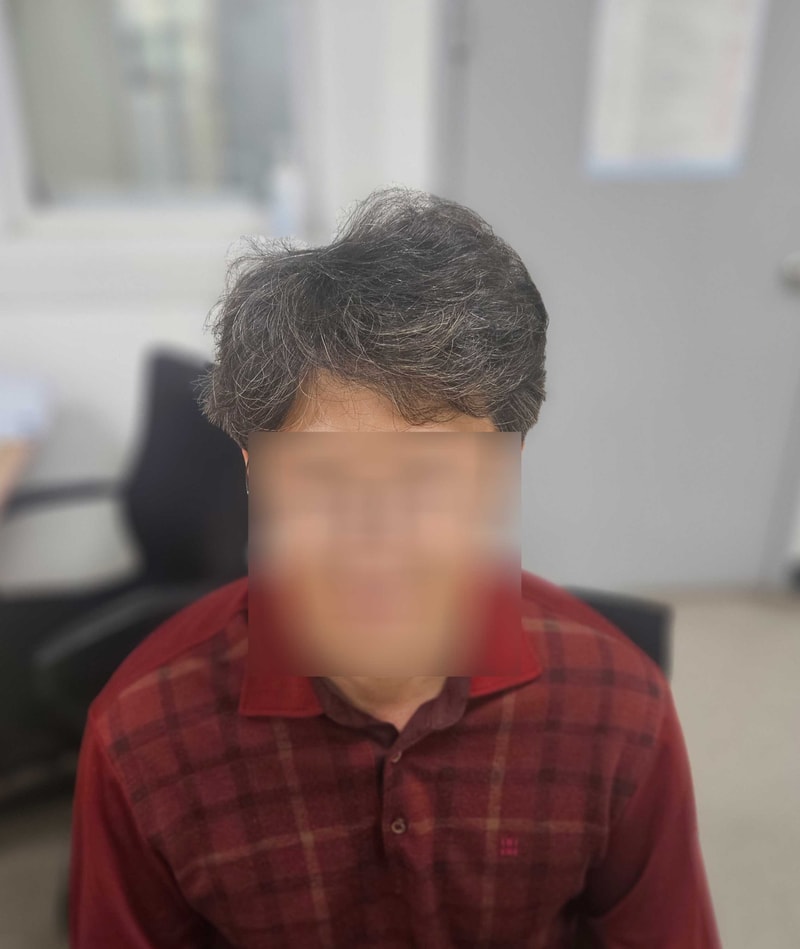 모발이식2년차.jpg