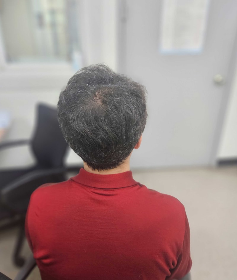 다나성형외과비절개모발이식후기.jpg