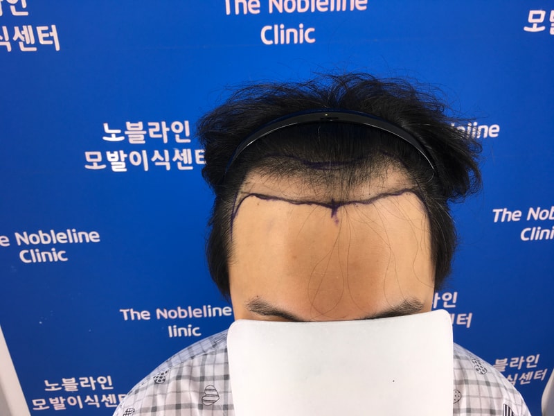 150일 되었습니다 머리 심었다는 사실을 가끔씩 잊을 정도로 좋습니다