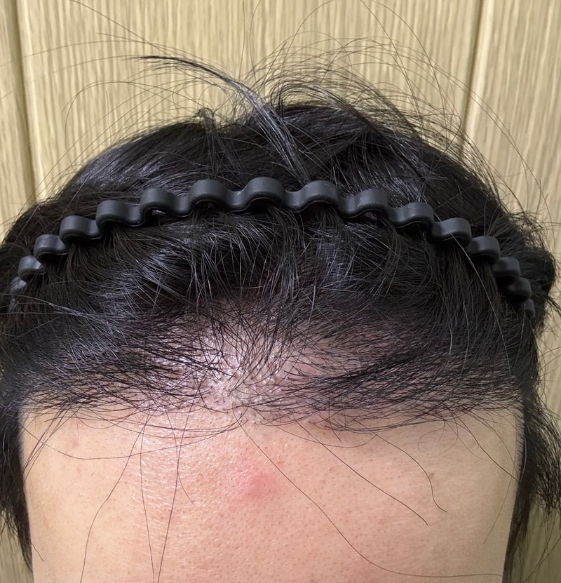 ニューヘアー3ヶ月目 非切開植毛 体験談/1500株