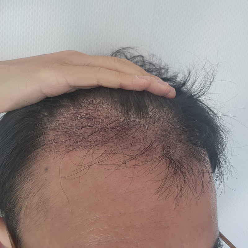 3. 수술후_3개월_셀카_1.jpg
