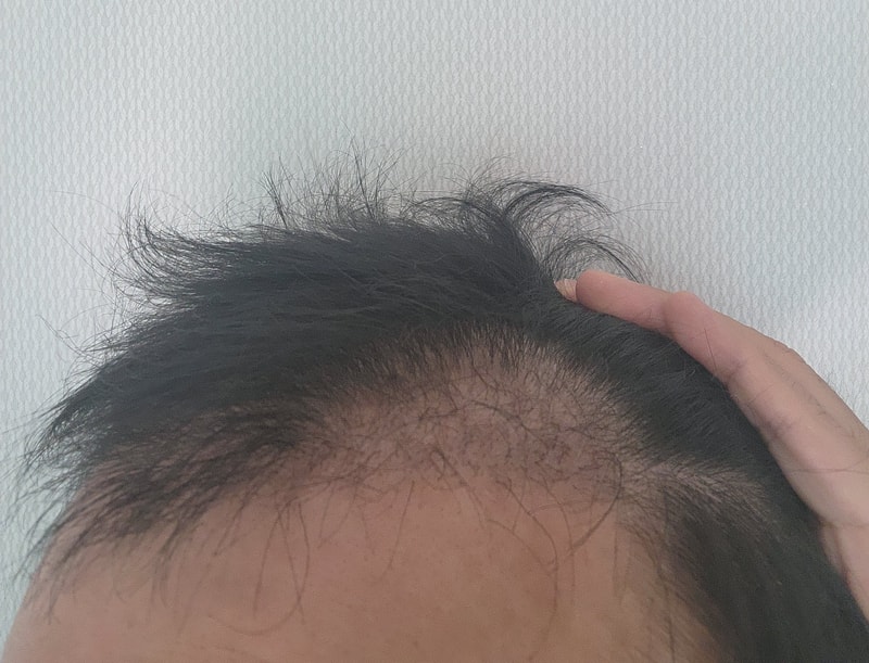 3. 수술후_3개월_셀카_2.jpg