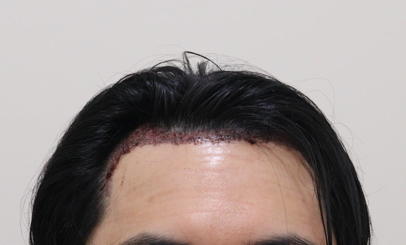 2. 수술후_1일_1.JPG