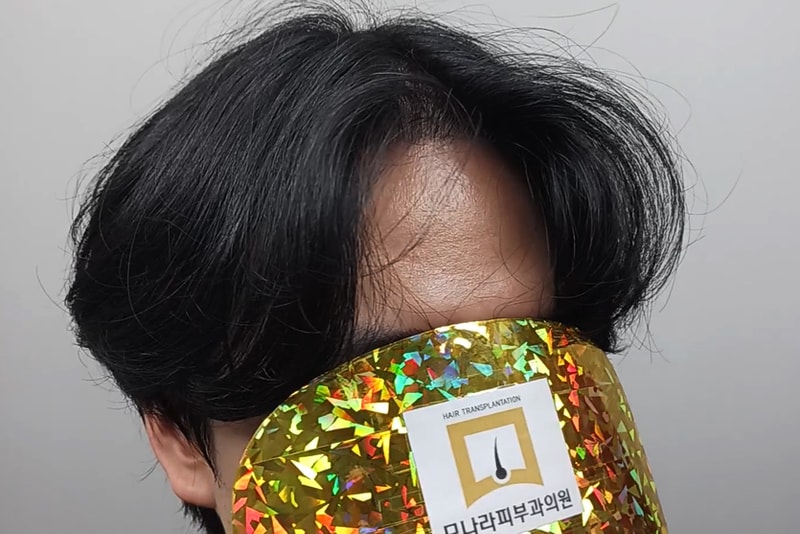 モナラ皮膚科植毛12ヶ月経過！ 望んでいたヘアスタイル完成！