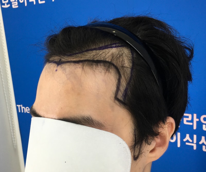 구렛나루, M자 이식 90일