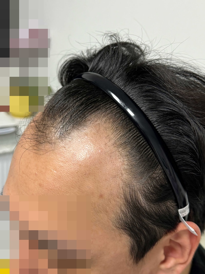 모발이식받기전.jpg
