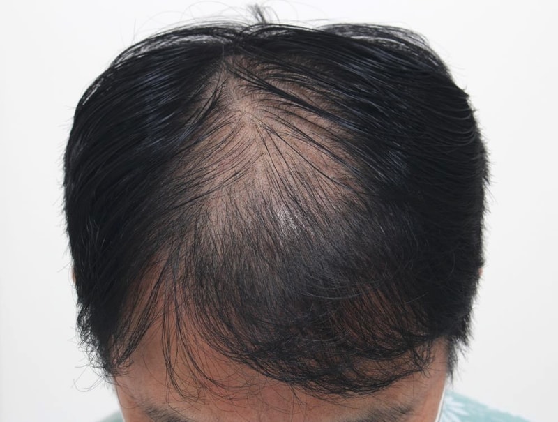 부산 포헤어의원 40대 정수리+전두부탈모 비절개슬릿 모발이식 1년 후기