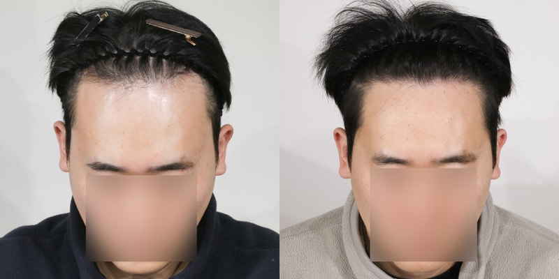 (사진후기) 압구정 모우림의원 4천모 모발이식 1년차 경과 후기