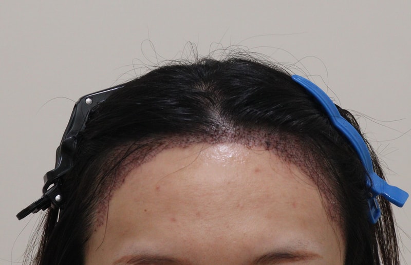 2. 수술후_1일_1.JPG