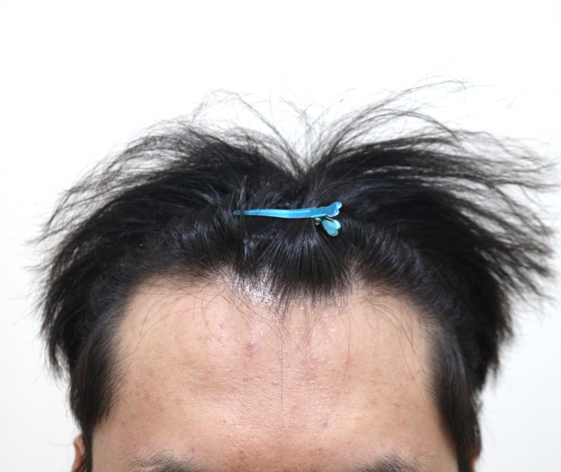 6개월지나니 진짜 자연스럽네요