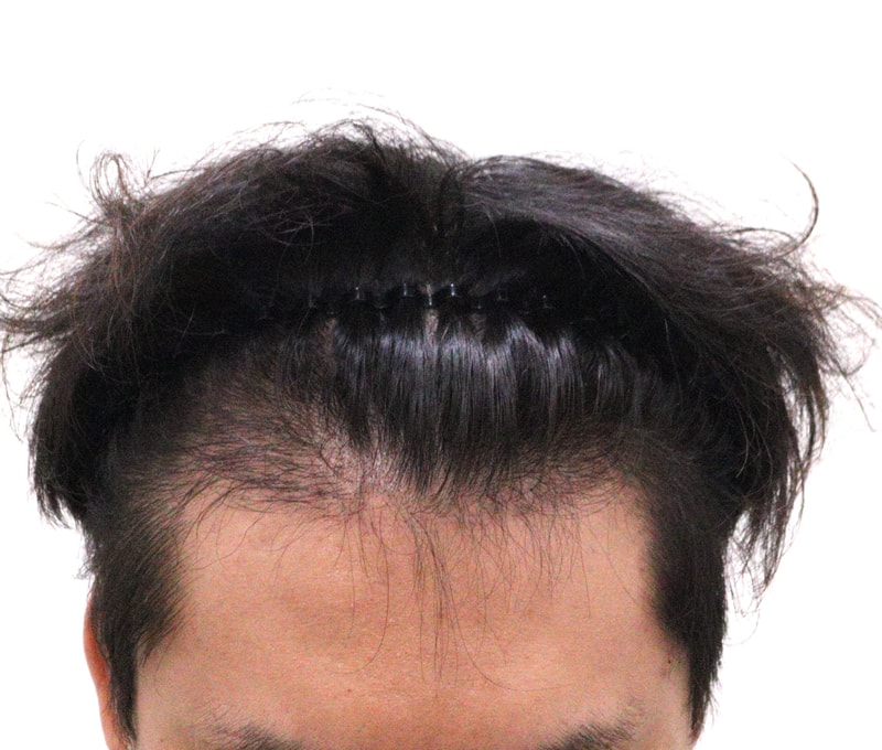 4. 수술후_6개월_1.JPG