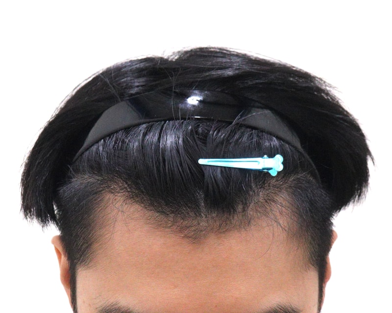 3. 수술후_6개월_2.JPG